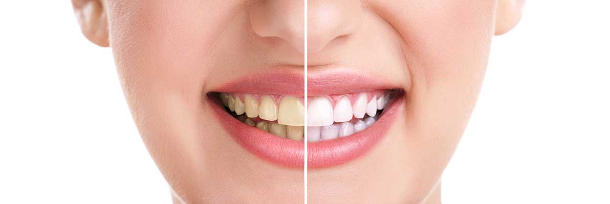 Copperstone Dental | Teeth Whitening For Life